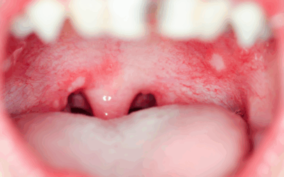 Bioinicia manufactures a new dressing that will revolutionize the treatment of oral lesions