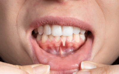 Electrospinning for gum tissue regeneration